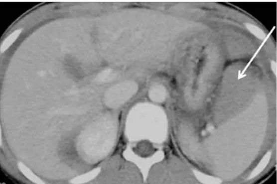 Gambar 12. Cedera limpa grade II pada bocah 13 tahun terluka setelah berkelahi. CT-scan  menunjukkan hematoma subkapsular melibatkan 30% -40% dari luas permukaan limpa (panah)