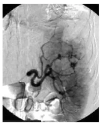 Gambar 18. Arteriogram yang diperoleh dengan injeksi kateter arteri utama lien menunjukkan  beberapa daerah ekstravasasi agen kontras parenkim.