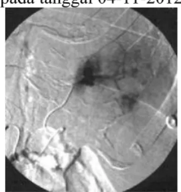 Gambar 20. Arteriogram lienalis selektif menunjukkan pseudoaneurysms traumatis dengan  ekstravasasi di kutub atas.