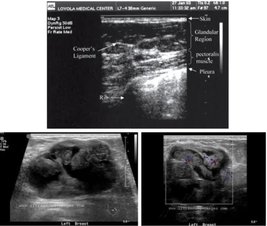 Gambar 4.  Gambaran  USG. Gambaran USG mammae normal  (atas);  Gambaran  USG tumor filoides (kiri) dengan color Doppler (kanan) 