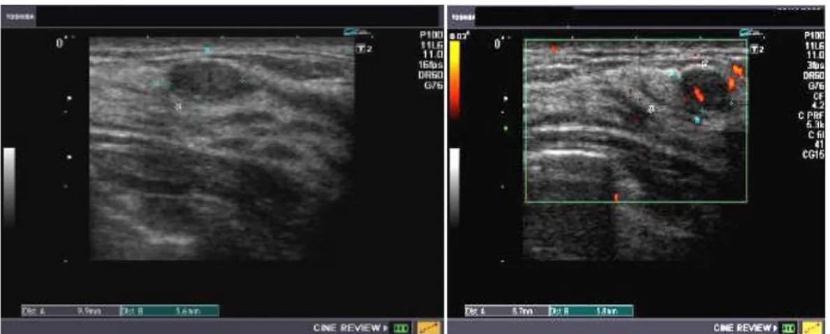 Gambar 8. Gambaran USG fibroadenoma kiri) dan dengan color Doppler (kanan) 