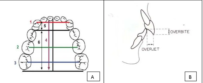 Gambar 2. (A) (1) Lebar Interkaninus, (2) Lebar Interpremolar, (3) Lebar Intermolar, (4) Panjang lengkung gigi, (5) Panjang segmen anterior, (6) Panjang           segmen posterior18  (B) Overjet dan overbite4 