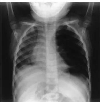 Gambar 2.5.  A.Foto thorax posteroanterior yang menunjukkan benda asing radioopak pada  cabang bronkus utama dextra