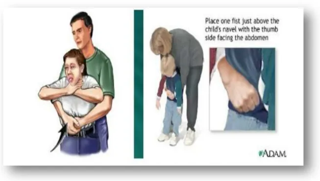 Gambar 2.7 Perasat Heimlich 