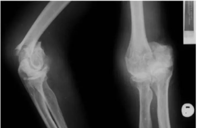 Fig. 4. Postoperative x-ray of surgically treated distal hu- hu-merus fracture.