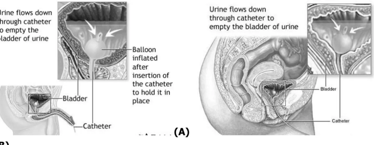 Gambar 7. Kateter Foley dengan balon  retensi. 