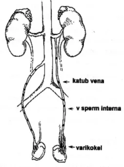 Gambar  5  :  Beberapa  kelainan  vena  spermatika  interna  kiri  menyebabkan  varikokel lebih sering terjadi di sebelah kiri