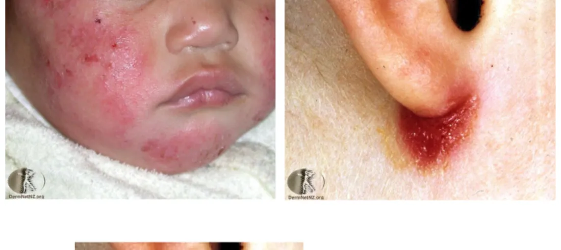 Gambar 3: Dermatitis Atopik Infantil (Simpson E.L., &amp; Hanifin J.M., 2005).
