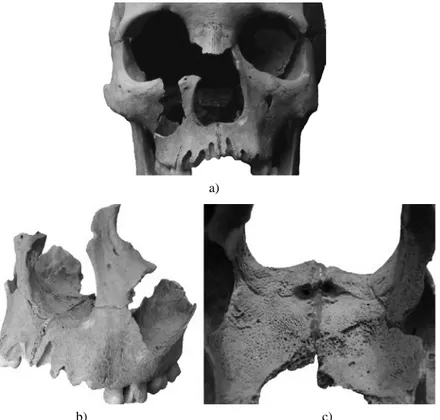 Fig. 10: The margin of the apertura piriformis is smoothed, the anterior nasal spine is destroyed (a),  traces of inflammation in the nasal cavity (b–c; leprosy, Obj.: 3254)