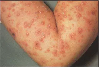 Gambar 2.13. Herpes Zoster 