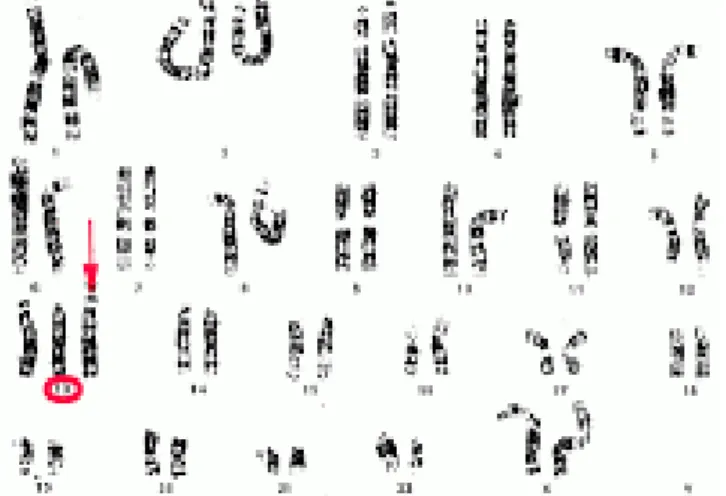 Gambar 4. Hasil Pemeriksaan Kromosom Trisomi 13  d.  Biopsi Vili Korialis 