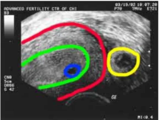 Gambar 5 : Contoh gambaran USG kehamilan ektopik