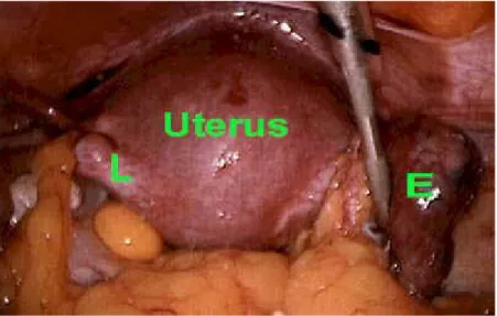 Gambar 8 : Kehamilan ektopik tuba kanan yang terlihat pada laparaskopi.