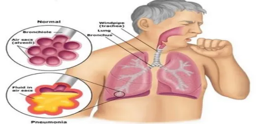 Gambar 1. Penyakit Pneumonia