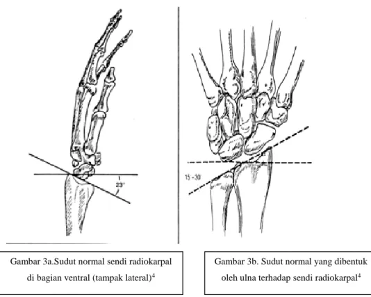 Gambar  1b  memperlihatkan  sudut  normal  yang  dibentuk  tulang  ulna  terhadap sendi radiokarpal, yaitu 15 - 30 derajat