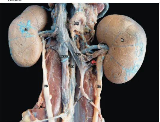 Fig. 1. Photomacrography showing the duplicity of the CVC and two renal veins in both kidneys: 