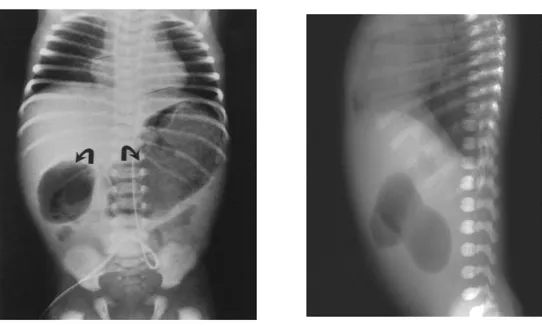 Gambar  4.  Foto  polos  abdomen  posisi  AP  dan  lateral  yang  memperlihatkan  gambaran  “the  double-bubble  sign”  pada  atresia  duodenum
