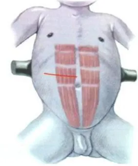 Gambar  6.  Transverse  supra- supra-umbilical abdominal incision. 13 