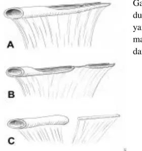 Gambar  1.  Tipe  anomali  rekanalisasi  duodenum.  Dilatasi  segmen  proksimal  yang  normal  diperlihatkan  pada   masing-masing  tipe