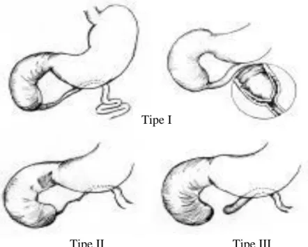 Gambar 2. Atresia duodenal; 3 tipe anatomis 9 Tipe I 