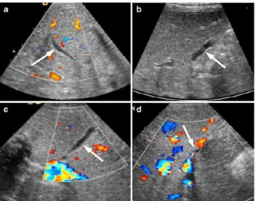 Gambar 4. The pseudo gallbladder sign (PsGB sign). Differentappearances (arrows) of the PsGB sign, which is defined as a fluid-filled structure <15 mm inlength in the region of theinterlobar   fissure   without   a   normal   gallbladder   wall   (seeFi