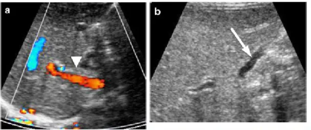 Gambar 6. The triangular cord sign (TC sign) in a BA patient. a The TC sign (arrowhead) measured 4.8 mm in this case of BA
