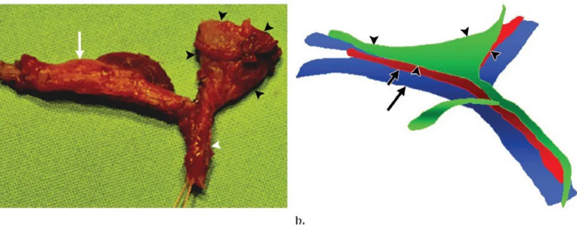 Gambar 11.  Surgical findings of biliary atresia. (a) Photograph of surgical specimen of obliterated extrahepatic bile ducts shows the fibrous ductal remnant   (black   arrowheads)   in   the   porta   hepatis,   atretic   gallbladder   (arrow), and fibrou