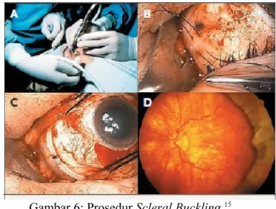 Gambar a) menunjukkan   tamponade di jahit pada permukaan luar sklera. Gambar b) menunjukkan lubang retina yang kelihatan