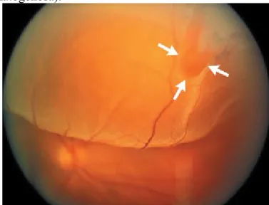 Gambar 3 : Ablasi Retina Regmatogenosa dengan horshoe tear 14 2. Terjadi akibat akumulasi cairan subretinal dengan tanpa adanya robekan retina