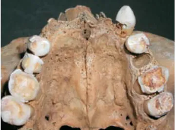 Figure 1. Torus palatinus, 26-35 years old female. Case ÞSK 51.