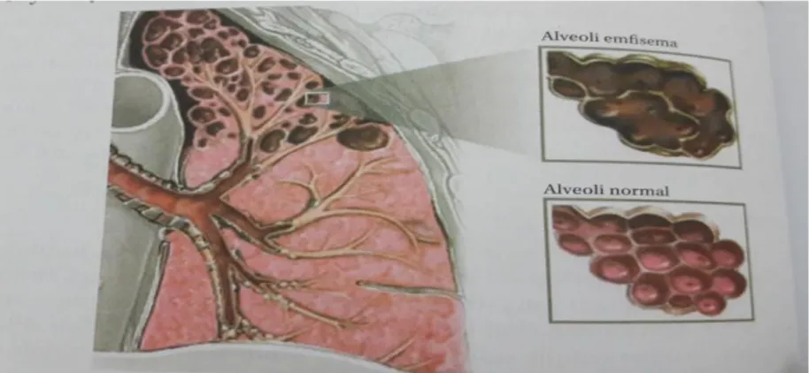 Gambar 2.6 Alveoli  Sumber : Yusa, 2016 