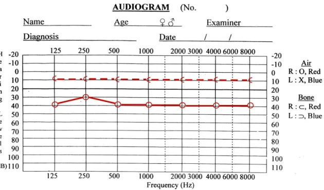Gambar 10. Audiogram tuli konduktif telinga kanan (BC normal 10db, AC&gt;25 db) 