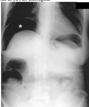 Gambar 6.  Foto polos abdomen  posisi  erect. Tampak udara   bebas   pada   subdiafragma   kanan (tanda bintang putih)