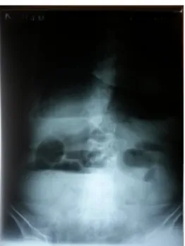 Gambar 1. Foto polos abdomen posisi erect VIII. RENCANA TERAPI