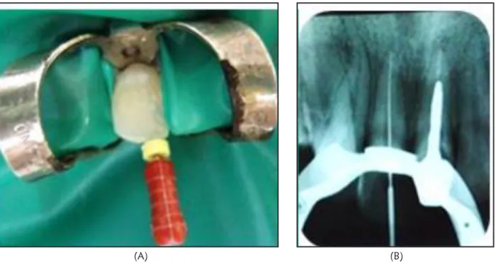 Gambar 1.   Foto intraoral dan foto radiograf awal,   karies dengan kedalaman mencapai  pulpa 