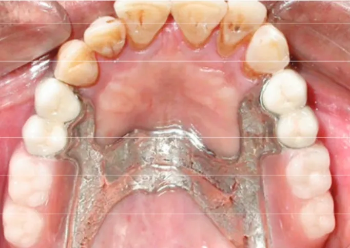 Gambar 17.  Kombinasi gigi tiruan dengan castable extracoronal  attachment (Gupta, 2013).