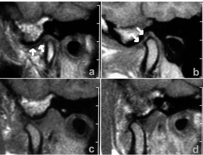 Fig. 1. Magnetic resonance imaging (1 T scanner) of temporomandibular joint with disc displacement with partial re- re-duction