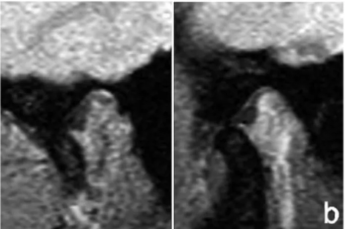 Fig. 3. Measuring the position of the disc and condyles in  the parasagittal plane by Kurita et al