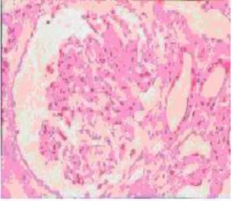 Gambar 8. Histopatologi gelomerulonefritis dengan mikroskop cahaya pembesaran 20× 
