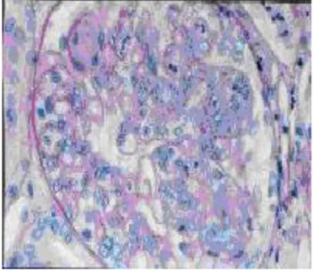 Gambar 10. Histopatologi glomerulonefritis dengan mikroskop elektron  keterangan gambar : 
