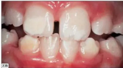 Gambar  2.6  Fluorosis  ringan  (Sumber: Louis S, Missouri. A Color Atlas Of Orofacial  health  and  Disease  in  Children  and  Adolescents  Diagnosis  and  Management