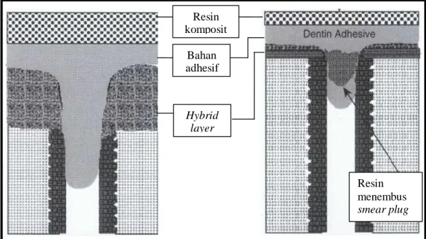 Gambar  7. A. Hybrid layer pada total-etch system, B.Hybrid layer pada self-etch   system 6