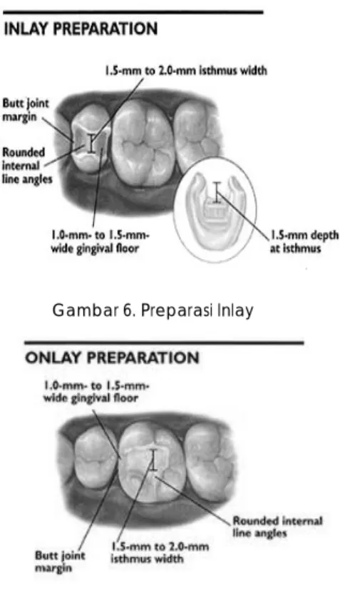 Gambar 6. Preparasi Inlay 