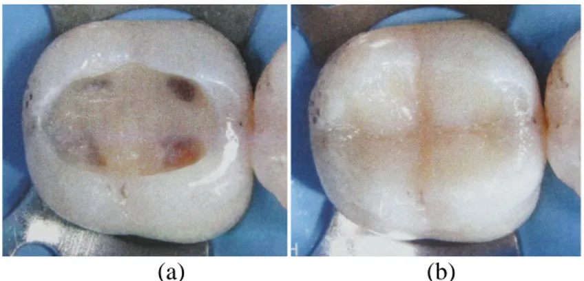 Gambar 3.8. Restorasi Direk Komposit setelah Perawatan Endodontik   (Brenna et al., 2009) 