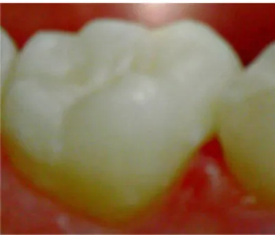 Gambar 3.13. Restorasi Komposit pada Gigi yang telah Dirawat  Endodontik  (Brenna et al., 2009) 
