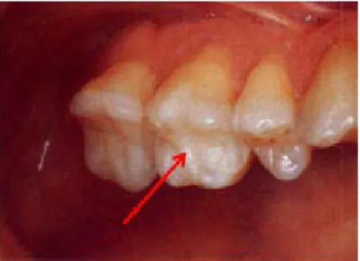 Gambar 3.14. Restorasi Onlay Porselen pada Gigi Molar Pertama (Aschheim &amp;  
