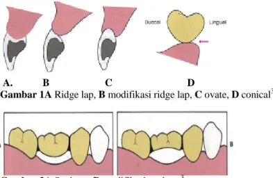 Gambar 1A Ridge lap, B modifikasi ridge lap, C ovate, D conical 3 