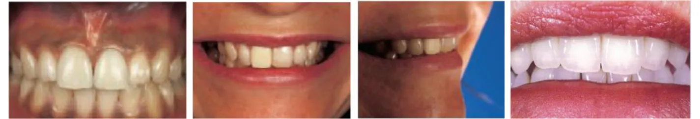 Gambar 6A Preparasi gigi 12,11,21 pada pembuatan GTJ dengan ovate pontic pada kasus kehilangan gigi 21, 5  B GTJ  sementara akrilik untuk penilaian estetik pasien, 5  C gigi 12,11,21 diekstraksi dan gigi 13,22 dan 23 dipreparasi untuk  pembuatan GTJ, D GTJ