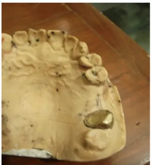 Gambar 1 Model gips rahang atas gigi 27  pasca  preparasi  persiapan  untuk  penempatan  mahkota  primer