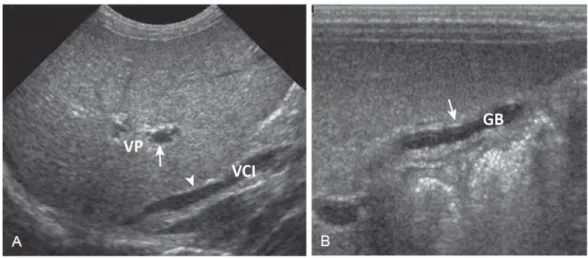 Gambar 2.2 Atresia bilier: Fitur sonografik. A. sonogram longitudinal dari bayi perempuan   berusia   22   hari   dengan  cholestatic   jaundice